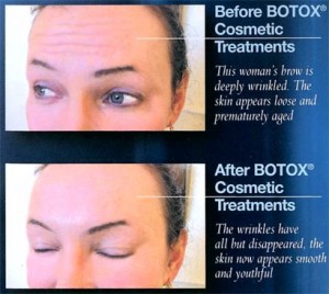 botox_brochure_scan